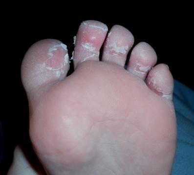 Ekzém alebo plesne?