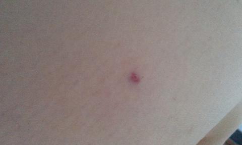 Fraxiparine a krv po vpichu