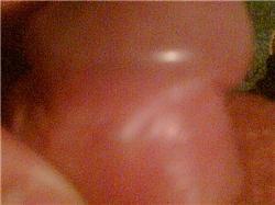 Je to vřídek syfilidu?