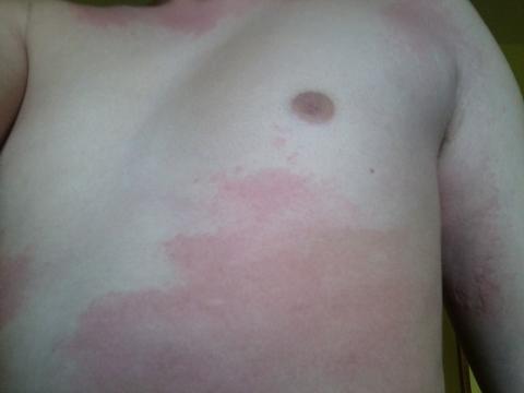 Vyrážky po celém těle