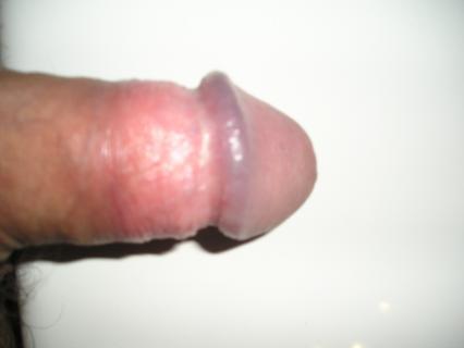 Začervenaná pokožka žaluda