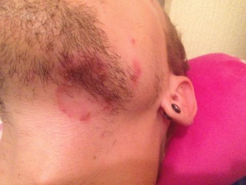 Zvětšující se vyrážka, strupy + foto